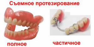 Съемные протезы