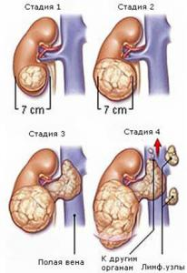 стадии рака почек стадии рака почек