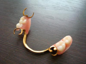 Бюгельный протез