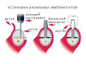 Этапы установки