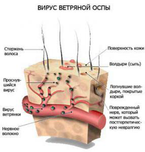 вирус ветряной оспы