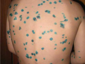 прижигание ветряной сыпи зелёнкой