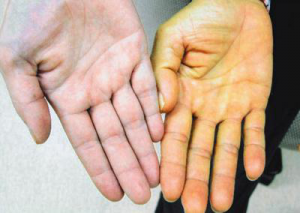 Нормальная рука и желтушная Нормальная рука и желтушная