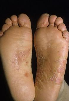 Грибок стопы