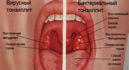 симптомы тонзиллита