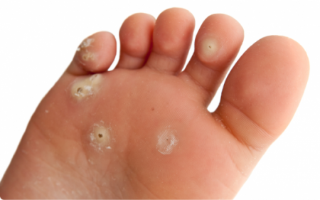 Подошвенные бородавки