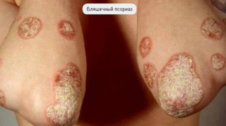 Бляшечный псориаз