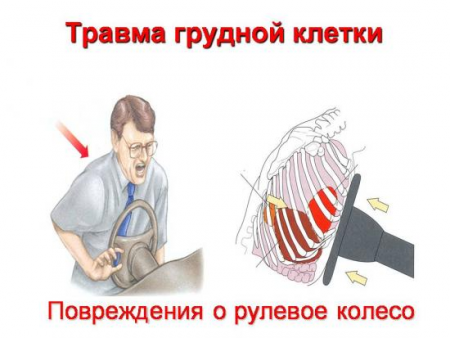 Травма грудной клетки