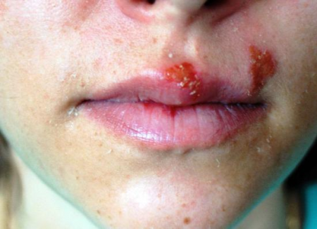 рана над губой рана над губой