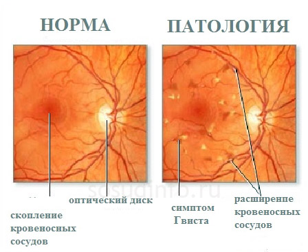 сетчатка глаза