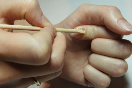 лечение грибка ногтей