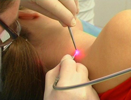 Криодеструкция родинки Криодеструкция родинки