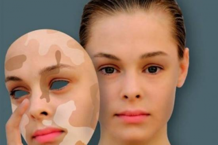 Лечение витилиго