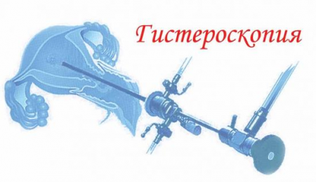 Гистероскопия