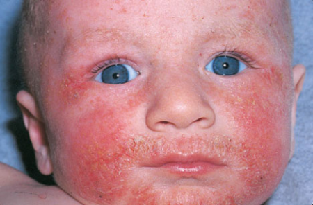 дерматит у младенца дерматит у младенца