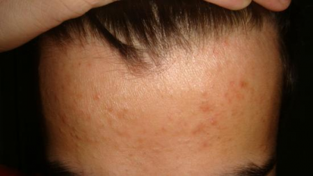 Следы от прыщей Следы от прыщей