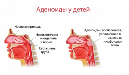 аденоиды