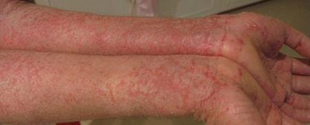 дерматит на руках дерматит на руках