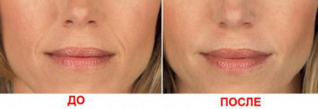 Биоревитализация