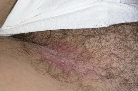 Паховая эпидермофития Паховая эпидермофития