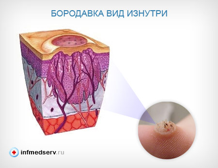 Бородавка