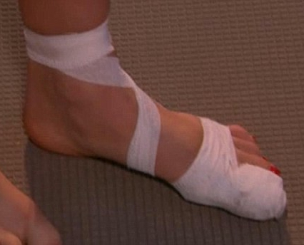 Перевязанный палец Перевязанный палец