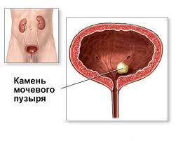 Цистолитиаз