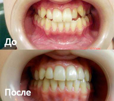 Брекеты Damon Clear: фото до и после