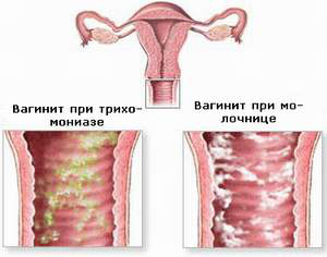 Нарушение нормальной микрофлоры влагалища