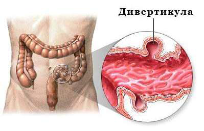 Дивертикулез кишечника фото