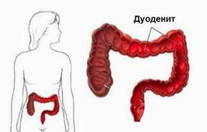 Дуоденит