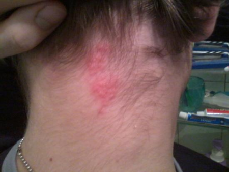 Сыпь на шее 