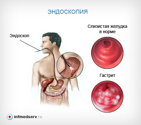 Эндоскопия