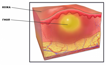 Подкожный прыщ Подкожный прыщ
