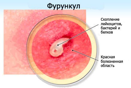 Фурункул