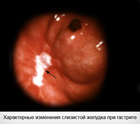 Эндоскопия гастрит