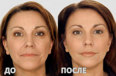 Гиалуроновая кислота до и после Гиалуроновая кислота до и после