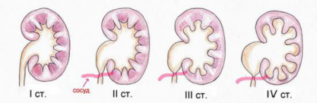 степени гидронефроза степени гидронефроза