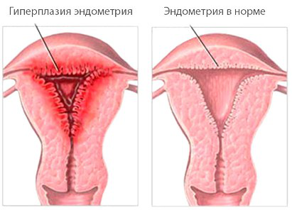 гиперплазия эндометрия 