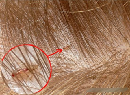 Вошь головная