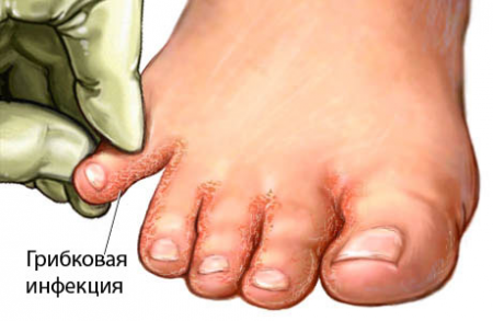 грибок на ногах