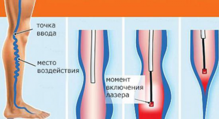 лазерное лечение варикоза лазерное лечение варикоза