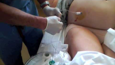 лечение асцита лечение асцита