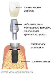 Строение имплантата