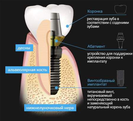 Строение зубного имлпнтата Строение зубного имлпнтата