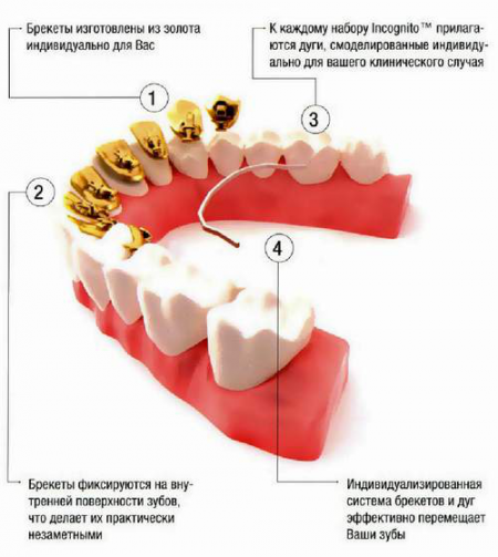 Составляющие брекет-системы