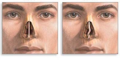 Нормалный и искривленный нос Нормалный и искривленный нос