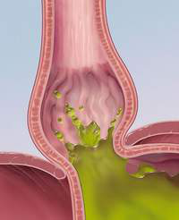 Попадание желудочного сока в пищевод Попадание желудочного сока в пищевод