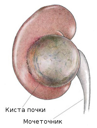 Киста почки фото