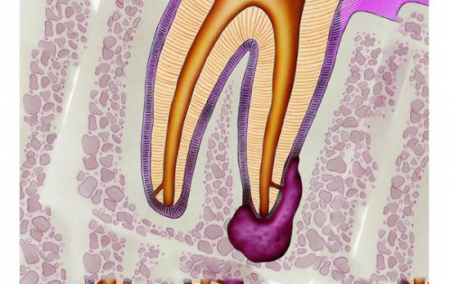 Зубная киста Зубная киста